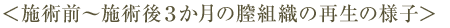 ＜施術前～施術後３か月の膣組織の再生の様子＞